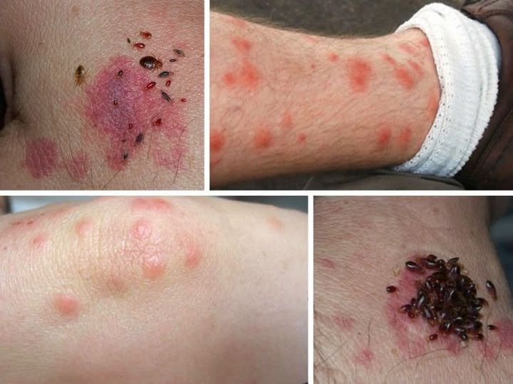 BE CAREFUL if you get these bruises on your body, it means you have Ca…