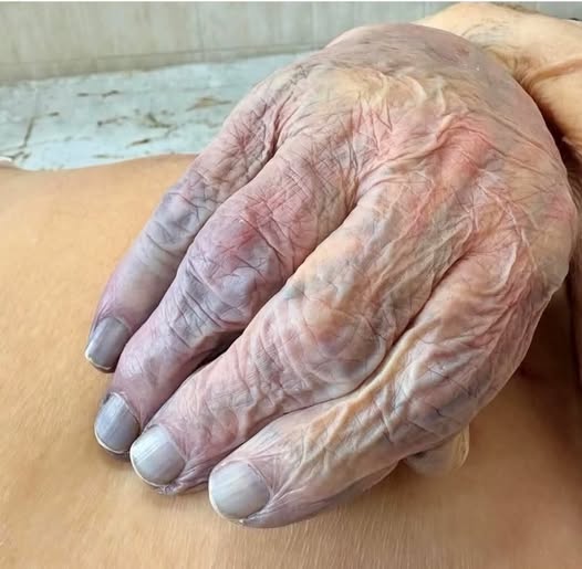 3 Signs on Your Hands That Could Indicate Heart Disease or Cancer