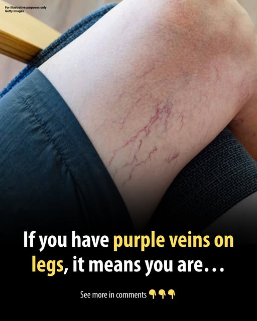 If you have purple veins on your legs, it means you are…